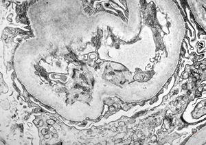 F,31y. | initial glomerular hyalinosis and sclerosis F,31y. | initial glomerular hyalinosis and sclerosis